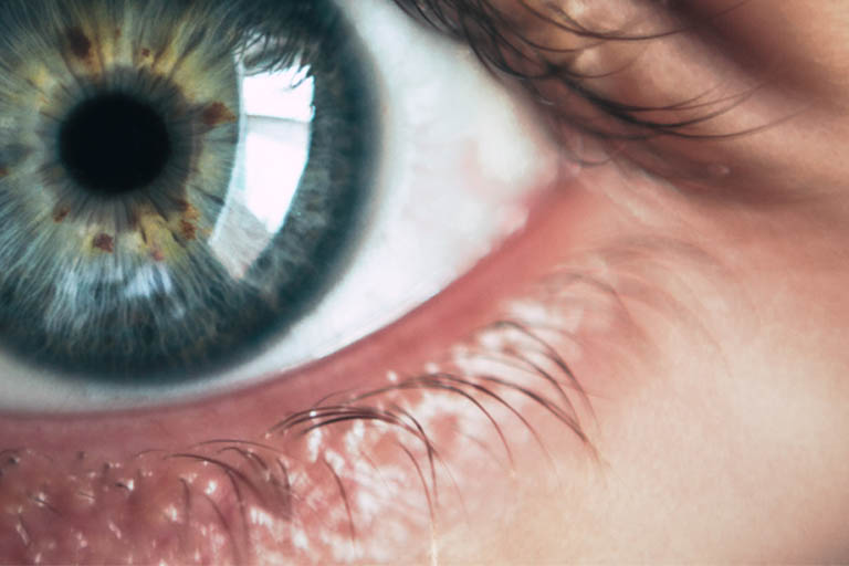 AugenCener-Selde-gesunde-Augen